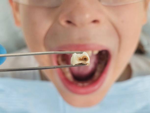 Best Dental Abscess Treatment in Graceville, FL